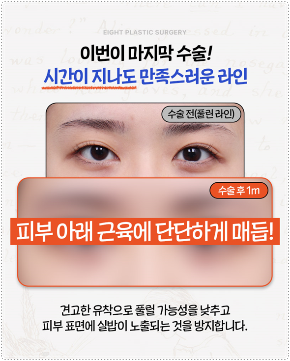 첫 쌍꺼풀 수술을 절개로 하고 눈 재수술은 매몰법(자연유착)으로 못하나? 비용 붓기는? 관련 이미지 8