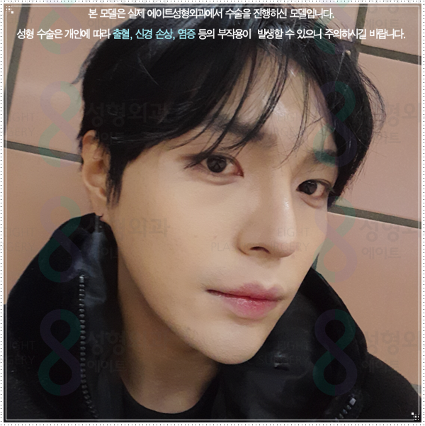 여자와 남자의 코성형 수술 차이점과 비용, 보형물 선택 가이드 관련 이미지 4