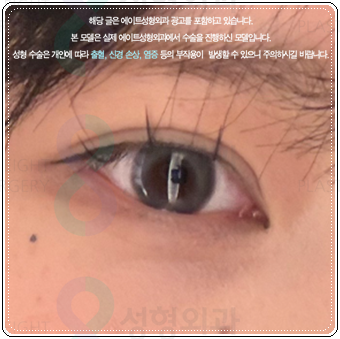 자연유착 매몰, 절개 차이 비교해봐요. 풀림 걱정없이 눈성형 비용과 후기 참고하는법 관련 이미지 1
