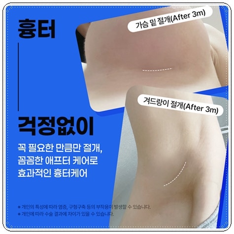 Can I Compare Breast Augmentation Surgery Costs? image 6