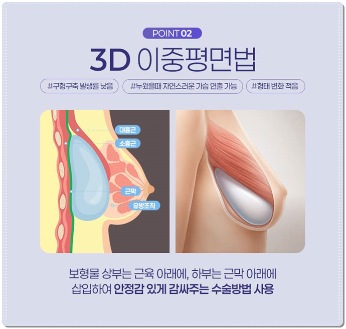 가슴성형 가격이 보형물마다 달라지는 이유는? 관련 이미지 6