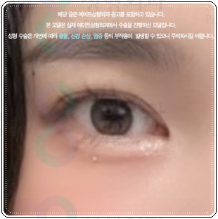 쌍커풀 하고 앞트임 수술을 해도될까? 쌍수 이후 라인 변화에 대해서 관련 이미지 5