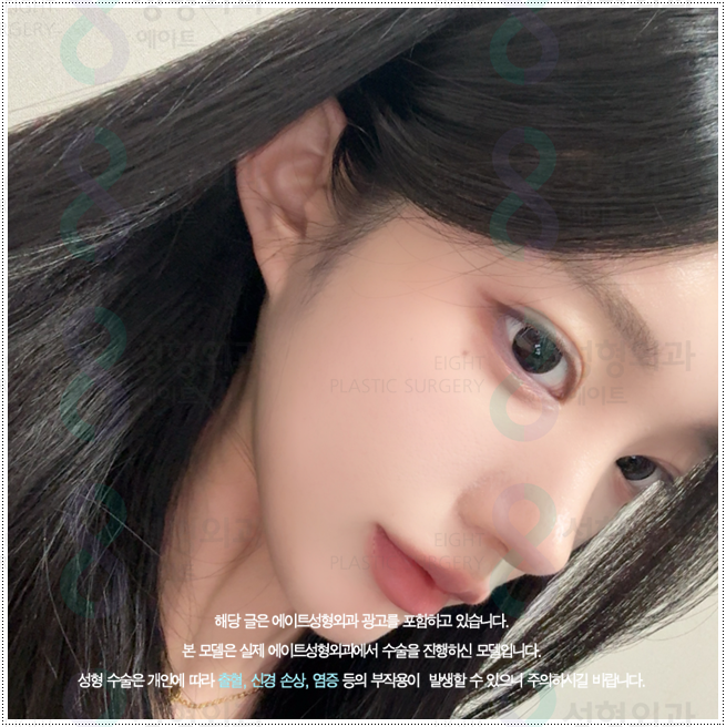 What Types of Rhinoplasty Are Available in Apgujeong? A Look at Bridge and Tip Surgery Prices and Recovery Times image 1