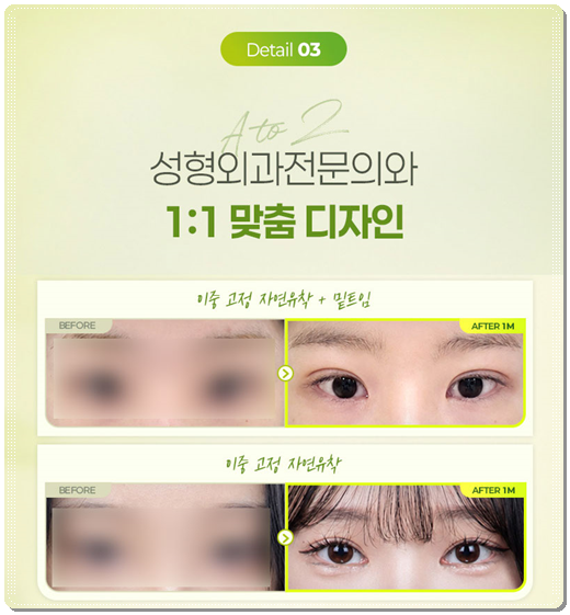 How Much Does Non-Incisional Double-Eyelid Surgery Cost? Comparing Suture and Incisional Methods image 12