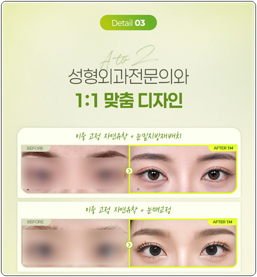 쌍커풀 하고 앞트임 수술을 해도될까? 쌍수 이후 라인 변화에 대해서 관련 이미지 10