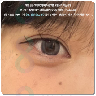 쌍꺼풀 라인을 다시 잡는 재수술, 매몰 방법과 비용은? 관련 이미지 3