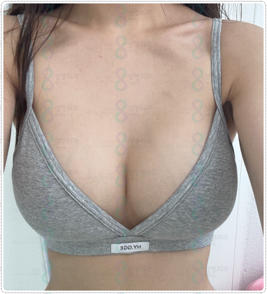 How Much Does Tear-Drop Breast Augmentation Cost? image 2