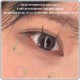 자연유착 매몰, 절개 차이 비교해봐요. 풀림 걱정없이 눈성형 비용과 후기 참고하는법 관련 이미지 2