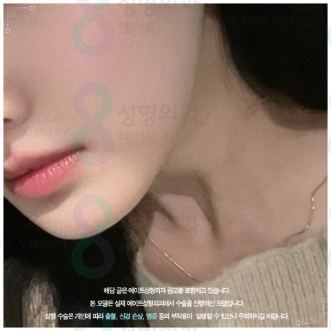 울쎄라 리프팅은 300샷으로 어느정도 효과가 있을까? 관련 이미지 1