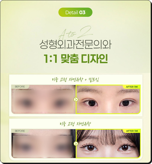 쌍꺼풀수술은 꼭 비절개가 좋을까? 부분절개와 절개의 비용 대비 효과는? 관련 이미지 10