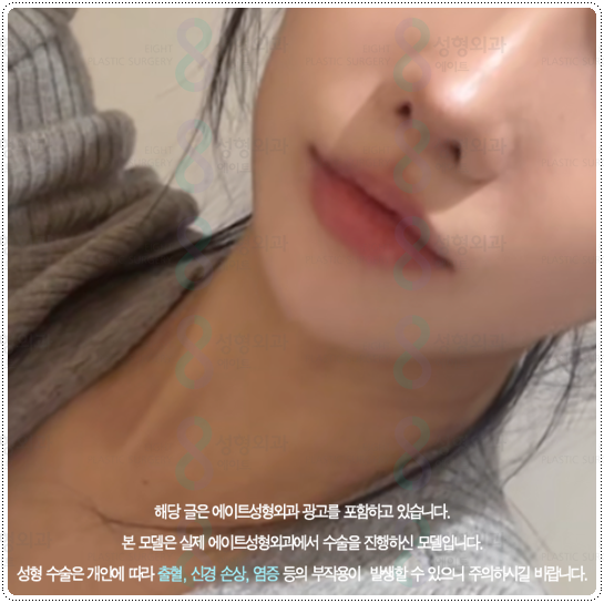 What Is the Difference Between 100 Shots and 300 Shots of Ulthera? Let’s Also Look at Ultherapy Prime Pricing and When Lifting Effects Appear image 5