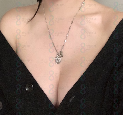 Drop-shaped Breast Augmentation Review: Feel of Drop-shaped Breast Augmentation / Breast Augmentation Cost and Price Information Sharing image 5