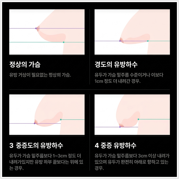 수술 비용이 부담되나요? 가슴수술 준비할 때 처진 가슴은 어떤 방법이 좋나요? 관련 이미지 6