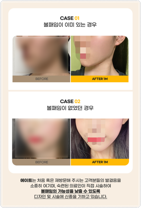 When You’re Unsure About the Difference Between 300 and 600 Ulthera Shots, Here’s What Matters More Than Cost image 11