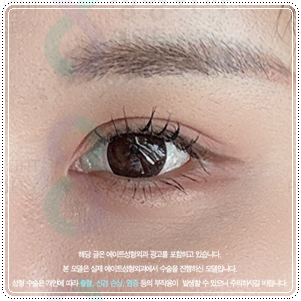 강남눈성형 | 쌍수 병원을 찾는다면? 비용, 후기, 선택전에 체크해보세요 관련 이미지 2