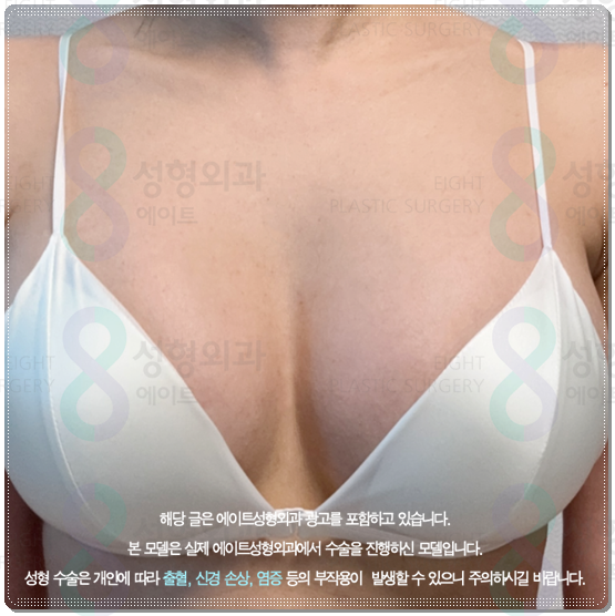 Cost Differences for Teardrop-Type Breast Surgery, Recovery Time for Swelling to Subside, and Implant Feel image 4