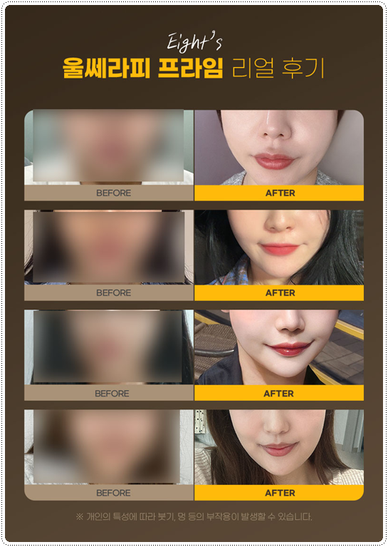 What Is the Difference Between 100 Shots and 300 Shots of Ulthera? Let’s Also Look at Ultherapy Prime Pricing and When Lifting Effects Appear image 7