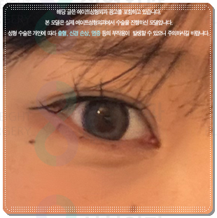 쌍꺼풀 라인을 다시 잡는 재수술, 매몰 방법과 비용은? 관련 이미지 5