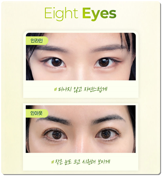 How Much Does Non-Incisional Double-Eyelid Surgery Cost? Comparing Suture and Incisional Methods image 7