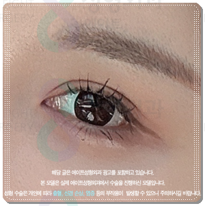Why Choose Partial Incision Instead of Non-Incision Double-Eyelid Surgery? Meaning, Cost, and When Does the Swelling Go Down? image 1
