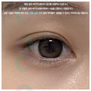 When Can You Wear Makeup After Non-Incisional Double Eyelid Surgery? Including Reviews of Swelling and Loss of the Fold image 3