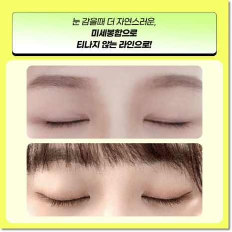 쌍수 가격은 평균적으로 얼마일까요? 매몰과 비절개? 절개 차이점까지 관련 이미지 8
