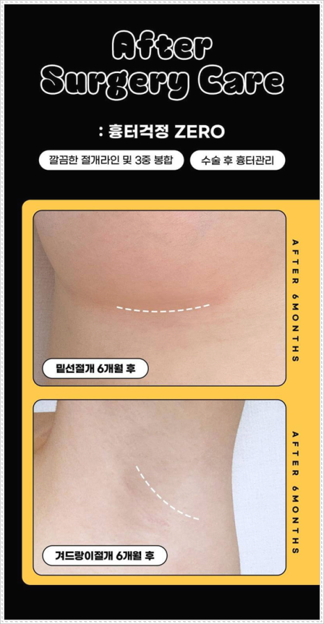 가슴성형수술 비용 얼마나 하나? 가슴성형 수술 후기와 부작용 낮추는 방법 관련 이미지 7