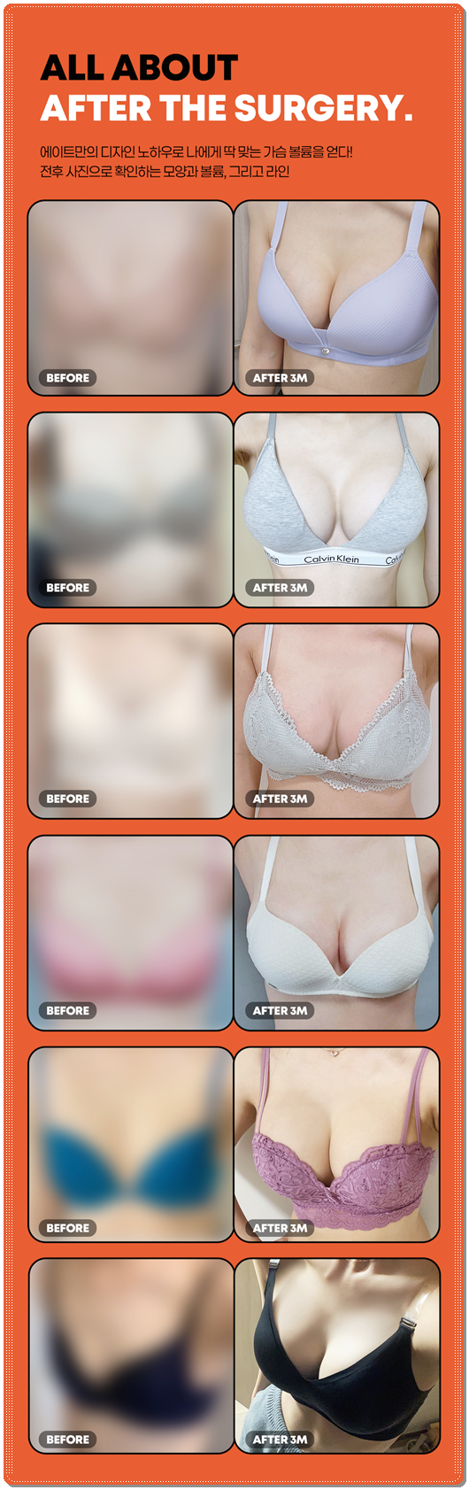 모티바 가슴수술 비용, 촉감, 후기 회복기간 특징에 대해서 관련 이미지 8