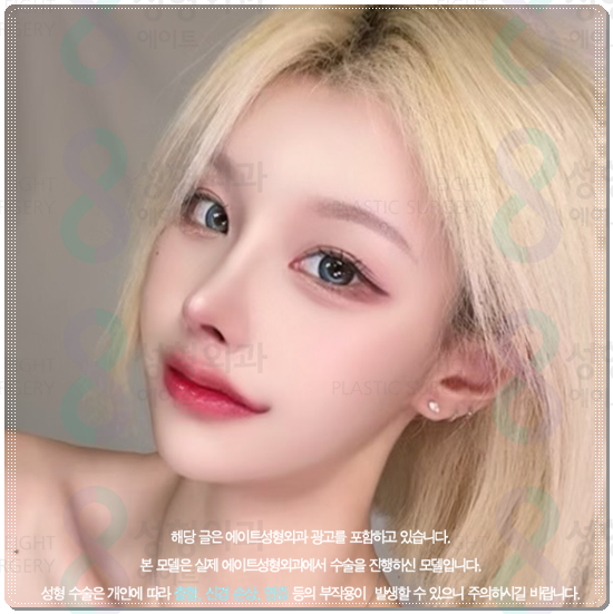 How Much Is a Reasonable Cost for Non-Incisional Ptosis Correction to Escape Sleepy-Looking Eyes? (Including the Differences from Incisional Surgery and Recovery Time) image 1