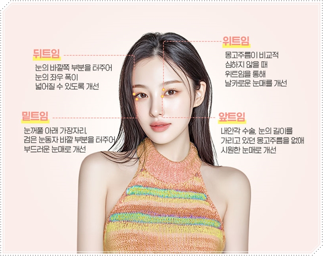 내 눈에 맞는 앞트임 필요할까? 수술 방법과 대략적인 비용 안내 관련 이미지 8