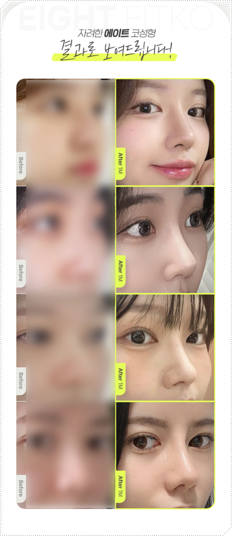 How Much Does a Non-Implant Tip Rhinoplasty Cost? Types of Materials Used in Nose Surgery and How It Differs from Bridge Surgery image 11