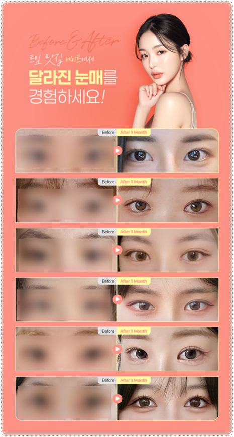 Preparing for the Cost and Swelling When Combining Medial and Lateral Canthoplasty with Double-Eyelid Surgery: A Comparison image 11