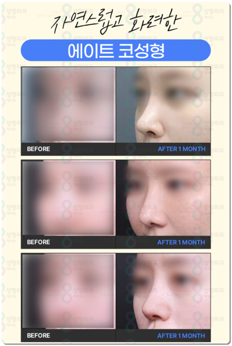 A No-Fail Guide to Comparing Rhinoplasty Costs: Recovery Period Management and Shared Reviews of Rhinoplasty Surgery image 6