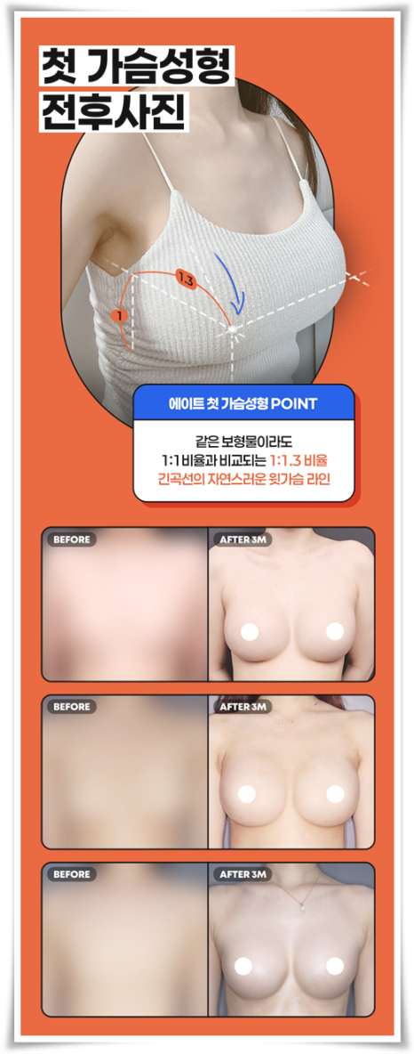 Best Places for Breast Augmentation: A Summary of Breast Implant Types, Pros, and Cons image 8