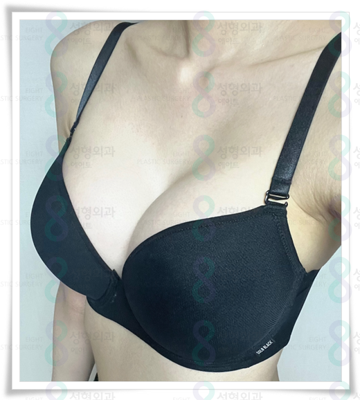 멘토 엑스트라 모티바 차이, 비용, 가슴보형물 종류 고르는법 관련 이미지 6
