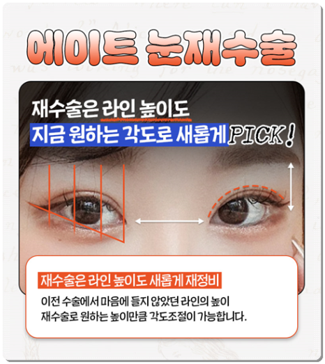 수술 가격이 다른 이유? 매몰과 절개 어떤 쌍꺼풀 재수술을 해야할까? 관련 이미지 9