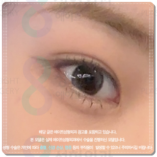 How Much Does Non-Incisional Double-Eyelid Surgery Cost? Comparing Suture and Incisional Methods image 5