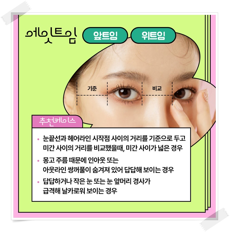 앞트임비용 얼마인지 알아보려면 관련 이미지 5