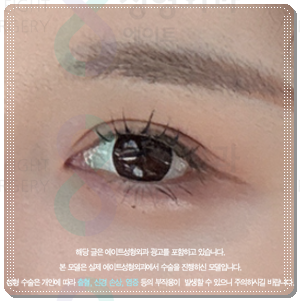 Why Choose Partial Incision Instead of Non-Incision Double-Eyelid Surgery? Meaning, Cost, and When Does the Swelling Go Down? image 2
