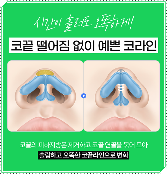 남자 코성형 종류 어떤 게 맞을까? 평균 비용부터 회복기간, 발품 팁까지 완벽 가이드 관련 이미지 22