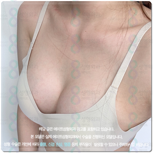 가슴 확대수술 비용, 후기 공유, 종류와 통증 붓기 기간까지 관련 이미지 1