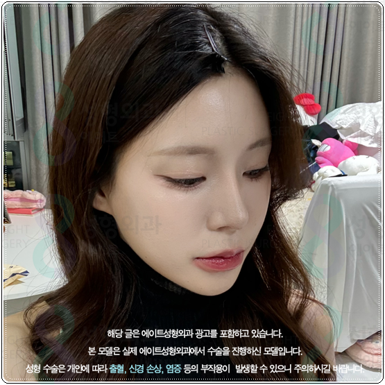 What Is the Average Price of Rhinoplasty When Hump Nose Surgery and Crooked Nose Surgery Are Performed Together? image 5