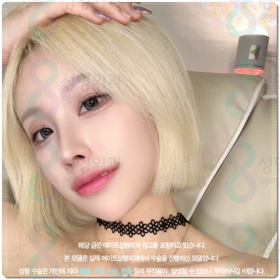 How Much Is a Reasonable Cost for Non-Incisional Ptosis Correction to Escape Sleepy-Looking Eyes? (Including the Differences from Incisional Surgery and Recovery Time) image 4