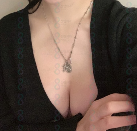 Drop-shaped Breast Augmentation Review: Feel of Drop-shaped Breast Augmentation / Breast Augmentation Cost and Price Information Sharing image 6