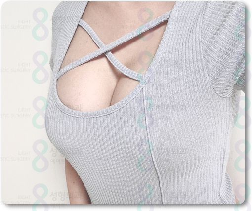Breast Augmentation Surgery Review: Implants, Recovery Time, and How to Minimize Side Effects image 3