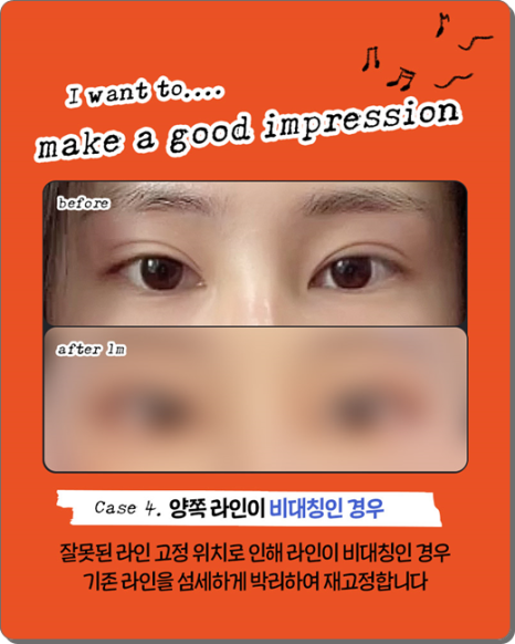 실패 없는 쌍꺼풀 재수술을 위해: 매몰법 특징부터 비용, 시기별 붓기 회복 과정 관련 이미지 14