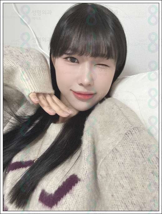 매부리코 수술 비용 후기 정보 총정리 관련 이미지 5