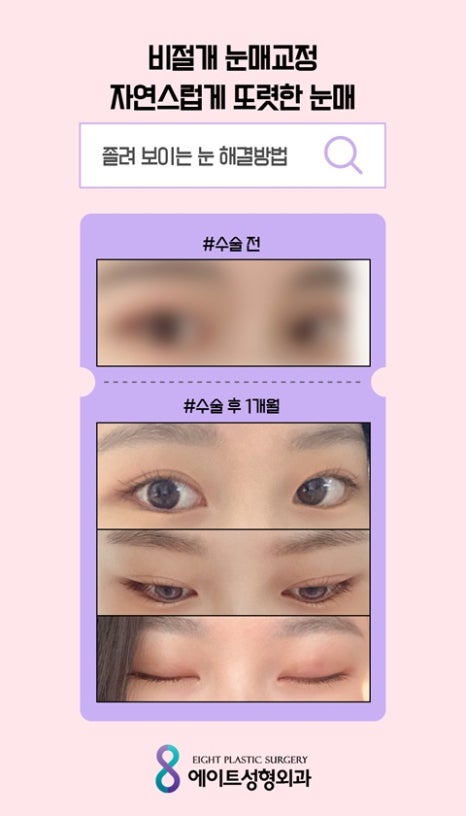 압구정눈매교정 눈매교정잘하는곳 눈매교정유명한병원 안검하수잘하는병원 관련 이미지 5