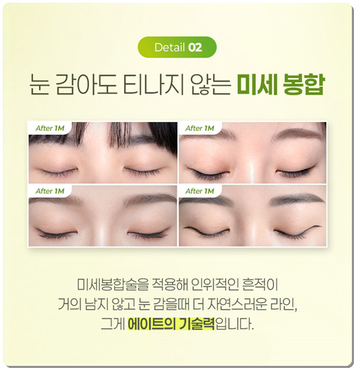 How Much Does Non-Incisional Double-Eyelid Surgery Cost? Comparing Suture and Incisional Methods image 10