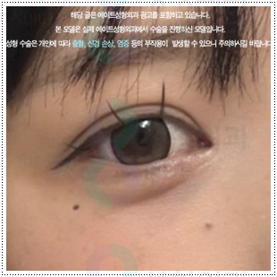 매몰쌍수와 앞트임 그리고 뒷트임, 밑트임까지 같이해도되나요? 관련 이미지 3